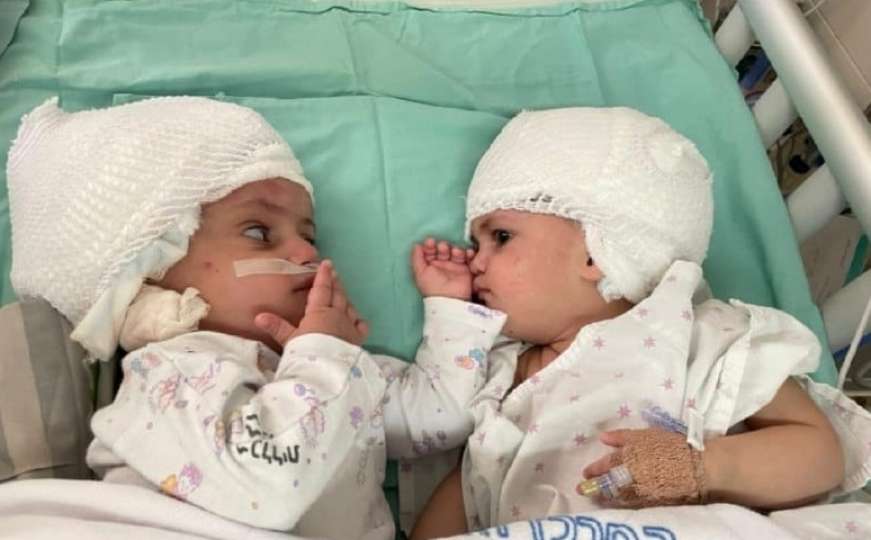 Sestrice se vidjele prvi put: Uspješno razdvojene sijamske blizanke