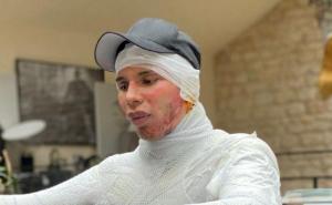 Nakon godinu dana progovorio o nesreći koja ga je unakazila