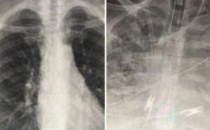 Pogledajte pluća dva pacijenta koji imaju koronu: Jedan se cijepio, drugi nije