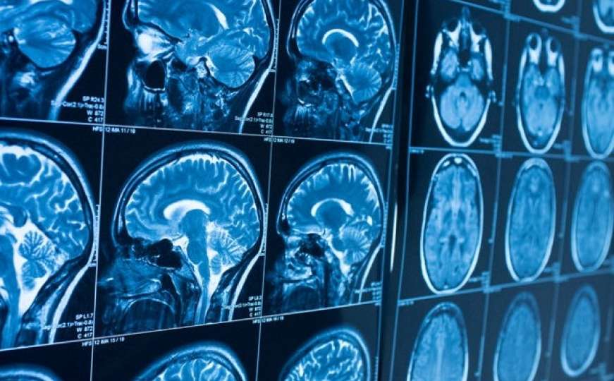 Naučnici objavili velike rezultate studije: Pogledajte šta COVID radi mozgu