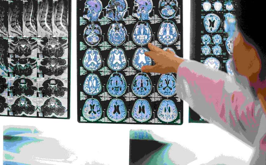 Mislili da je tumor: Ljekari nisu mogli vjerovati što je Amerikanki raslo u mozgu