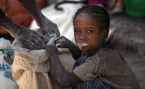 UNICEF: Više od pola miliona djece u Somaliji suočava se s pothranjenošću