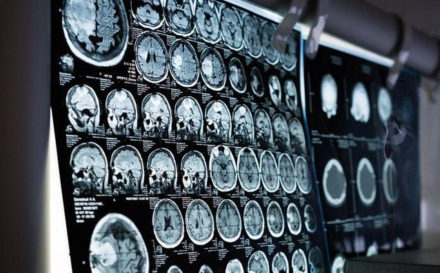 Naučnici snimali mozak čovjeka u trenutku smrti i došli do zapanjujućih otkrića