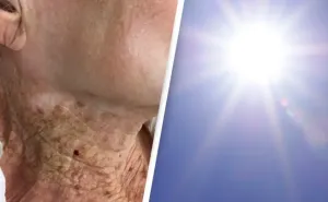 Šokantne slike 92-godišnjakinje koja decenijama koristi kremu za sunčanje na licu, ali ne i na vratu