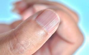 Promjene na noktima mogu signalizirati probleme sa srcem i plućima, a mogu ukazivati i na tumor