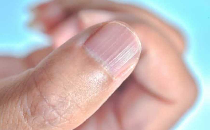 Promjene na noktima mogu signalizirati probleme sa srcem i plućima, a mogu ukazivati i na tumor