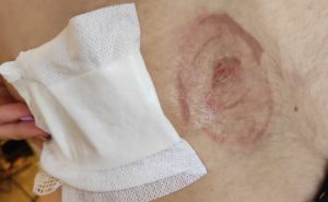 Suprugu mu na plaži u Hrvatskoj napala džinovska kornjača: "Brza reakcija nije ublažila krvarenje"