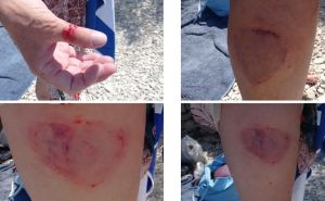 Novi napad kornjače u Hrvatskoj: Pogledajte kako izgleda noga žene nakon ugriza