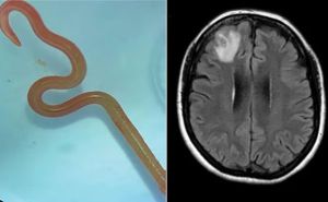Doktori ostali u šoku nakon operacije: Ženi iz mozga izvadili crva dugog osam centimetara