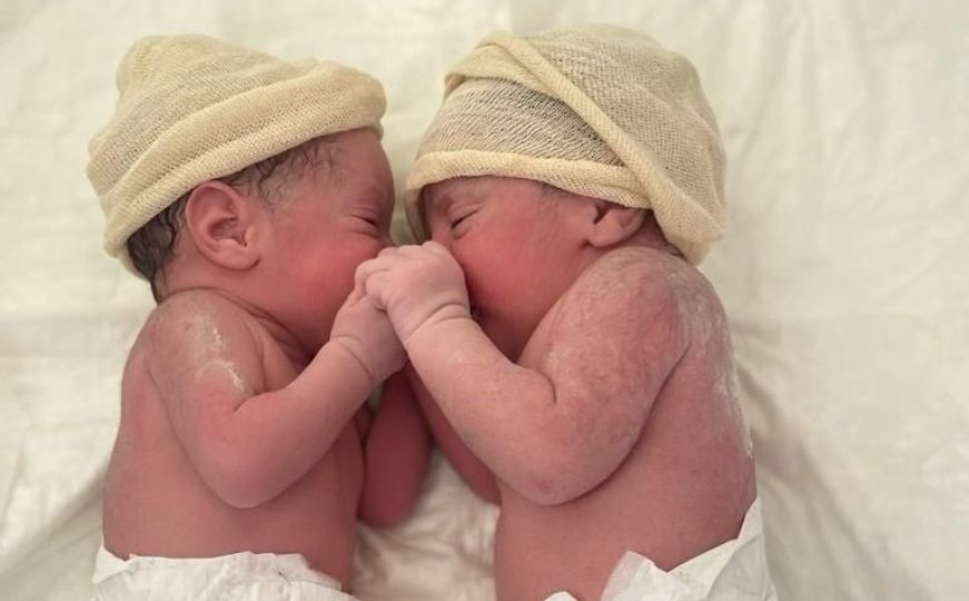 'Porod sirene' se dešava jednom u 80.000 slučajeva: Pogledajte fotografiju blizanaca iz Španije