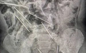 Dječak progutao osam igala - doktori mu spasili život