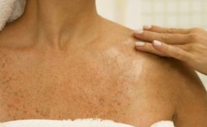 Simptomi raka kože: Zašto rozi osip može biti upozorenje?