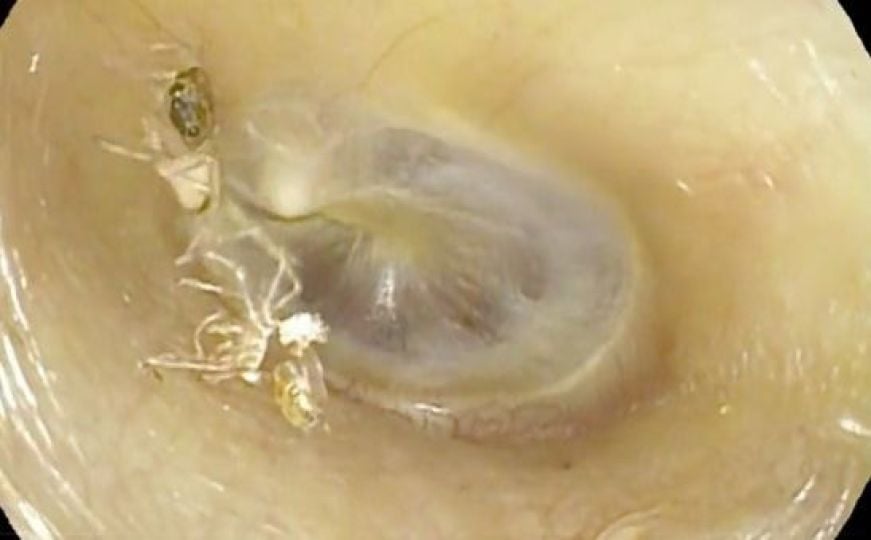 Žena se žalila na čudne bolove u uhu: Doktor ostao šokiran nakon pregleda, iz uha je izvadio ovo