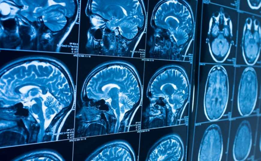 Naučnici napravili najveću mapu mozga ikad: Veliki pomak u liječenju demencije i drugih bolesti
