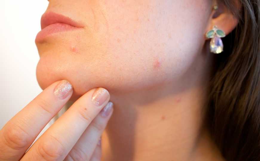 Šest načina da ublažite simptome atopijskog dermatitisa