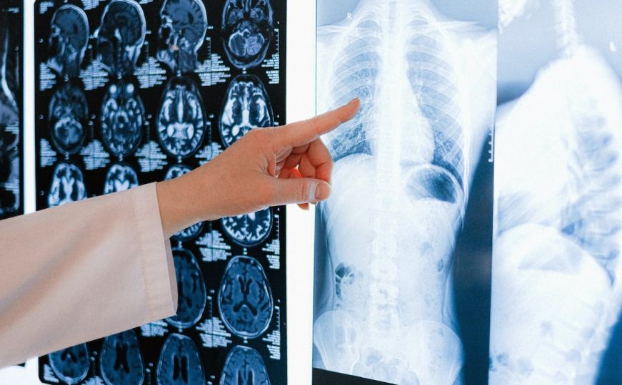 Misteriozna bolest širi se svijetom: Šta je sindrom bijelih pluća?