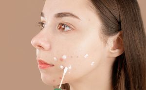 Koji su sastojci u kozmetičkim preparatima ključni za njegu lica sklonom aknama?