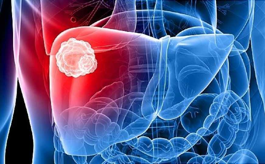 Da li ste se ikada zapitali kako nastaje masna jetra: Ovo su uzroci i simptomi