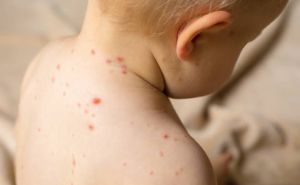 Splitu prijeti epidemija opasne zarazne bolesti? Sve gore i gore, u BiH je eksplodirala