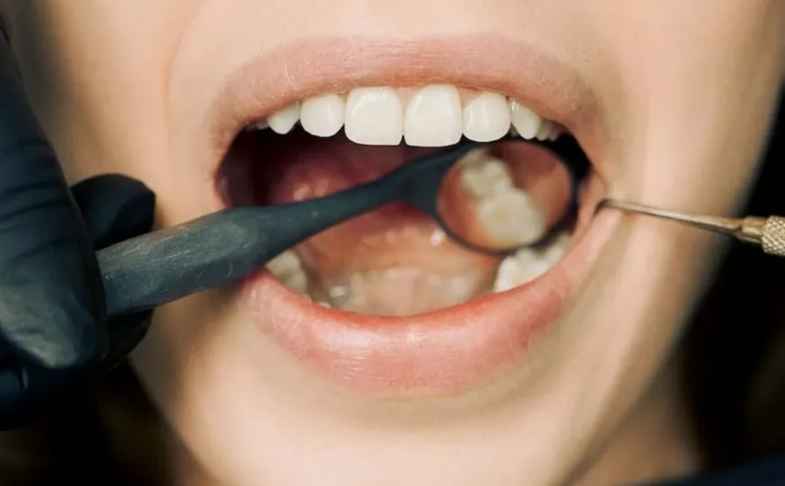 Stomatologa zgrozio novi trend sa zubima na TikToku: 'Molim vas da ne radite to! Nije nikako dobro'