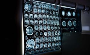 Revolucionarno otkriće: Nova metoda skeniranja mozga predviđa ovu opaku bolest i do 9 godina ranije