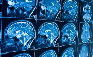 Hirurg otkrio jezivu činjenicu: Evo šta se dešava sa mozgom nako smrti - 'mnogi misle da je tu kraj'