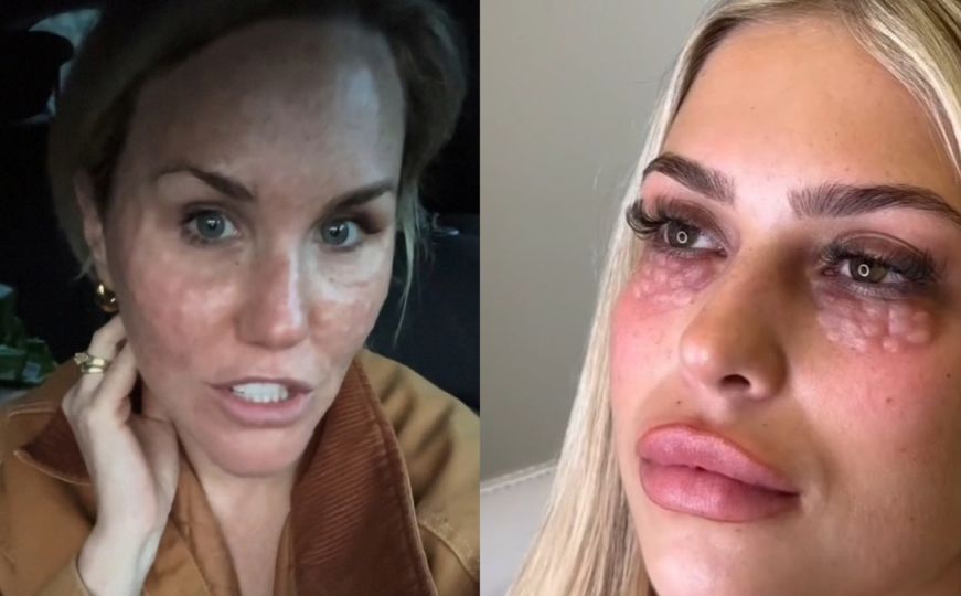 Ljekari upozorili na novi popularni beauty trend: Šteta na licu može biti trajna