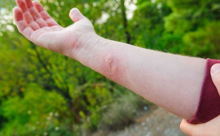 Efikasan trik za ubode ose, pčele i stršljena: Ovaj jednostavan korak uklanja bol i otok