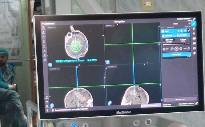 Historijski iskorak u Kantonalnoj bolnici Zenica: Prvi put urađena iglena biopsija mozga