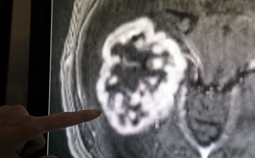 Kongres o kanceru: Lijekovi sljedeće generacije mogu biti prekretnica u liječenju