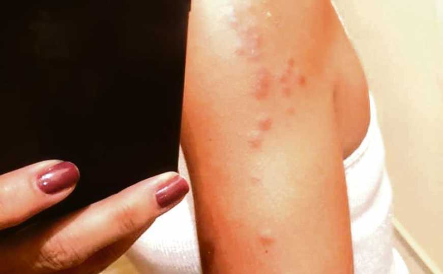 Stjenice u stanovima: Kako prepoznati njihov ugriz i suzbiti njihovo širenje