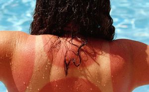 Efikasne metode protiv opekotina od sunca: Ovo je top 5 prirodnih rješenja