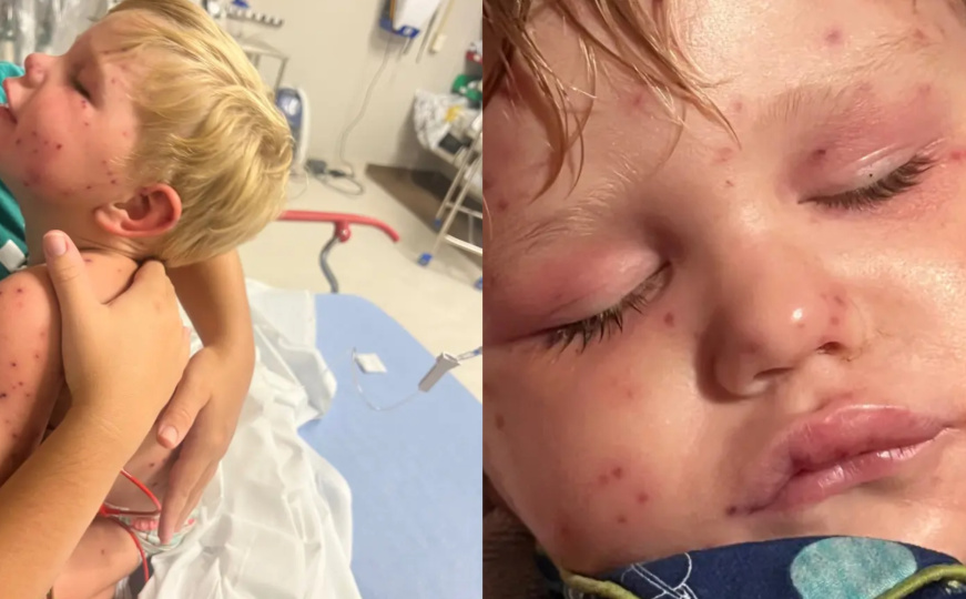 Dvogodišnjeg dječaka napao roj osa: Otkazali mu vitalni organi nakon više od 150 uboda