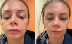 Istiskala bubuljicu, pa joj se paraliziralo lice: Ni slučajno ne dirajte 'Trokut smrti'