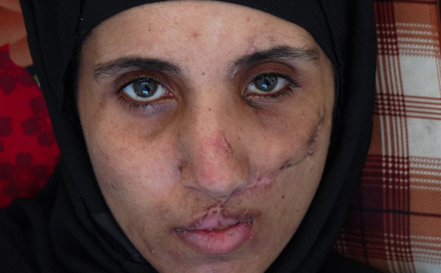 Paralizirana, trudna i sama u ruševinama: Monina borba da spasi ranjenu djecu u Gazi