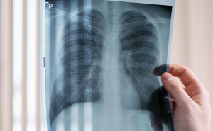 Zbog jakog kašlja mislili da ima rak pluća: Ono što su otkrili ih je ostavilo u nevjerici