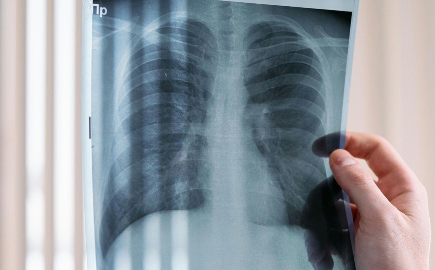 Zbog jakog kašlja mislili da ima rak pluća: Ono što su otkrili ih je ostavilo u nevjerici