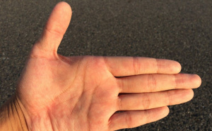 Prst vam se koči i bolno škljoca? Možda imate 'trigger finger'