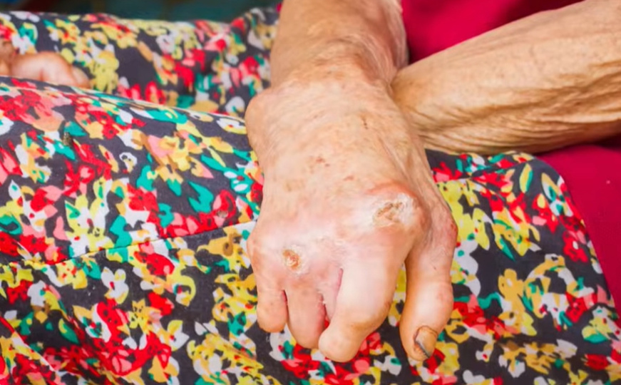 U Hrvatskoj potvrđen slučaj gube