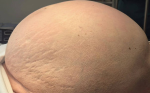 Nevjerovatna priča iz bh. susjedstva: Ženi uklonjen tumor težak 36 kilograma, mislila da je trudna