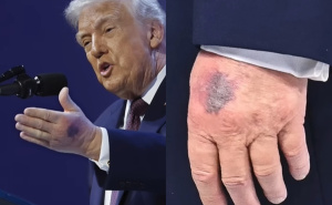 Bijela kuća demantuje tvrdnje da je bolestan: Poznat uzrok modrica na Trumpovim rukama