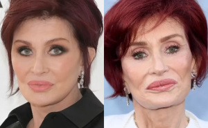 Užasavajuće posljedice Ozempica: Uništava izgled lica, najugroženije su starije osobe