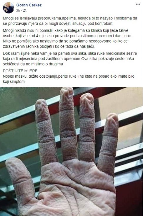 Čerkez objavio fotografiju ruke medicinske sestre - undefined