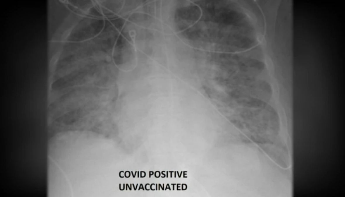 COVID / Doktor objavio snimak pluća vakcinisanih, i nevakcinisanih zaraženih pacijenata