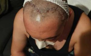 Foto: Ivan Andrijanić / Povrede koje je dobio tokom proslave