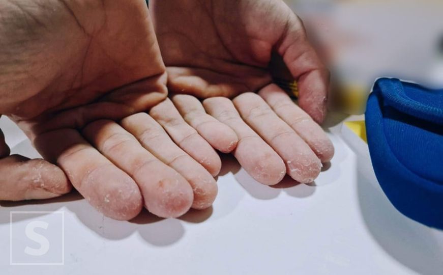 Ruke oboljelog od dijabetesa nakon mjesec dana bez senzora