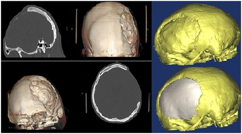 Preoperativni CT glave i formiranje modela na 3D printeru