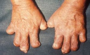 Foto: Wikipedia / Ruke teško oboljelih