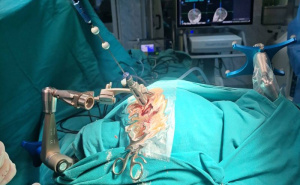 Foto: Kantonalna bolnica Zenica / Prvi put urađena iglena biopsija mozga