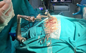 Foto: Kantonalna bolnica Zenica / Prvi put urađena iglena biopsija mozga